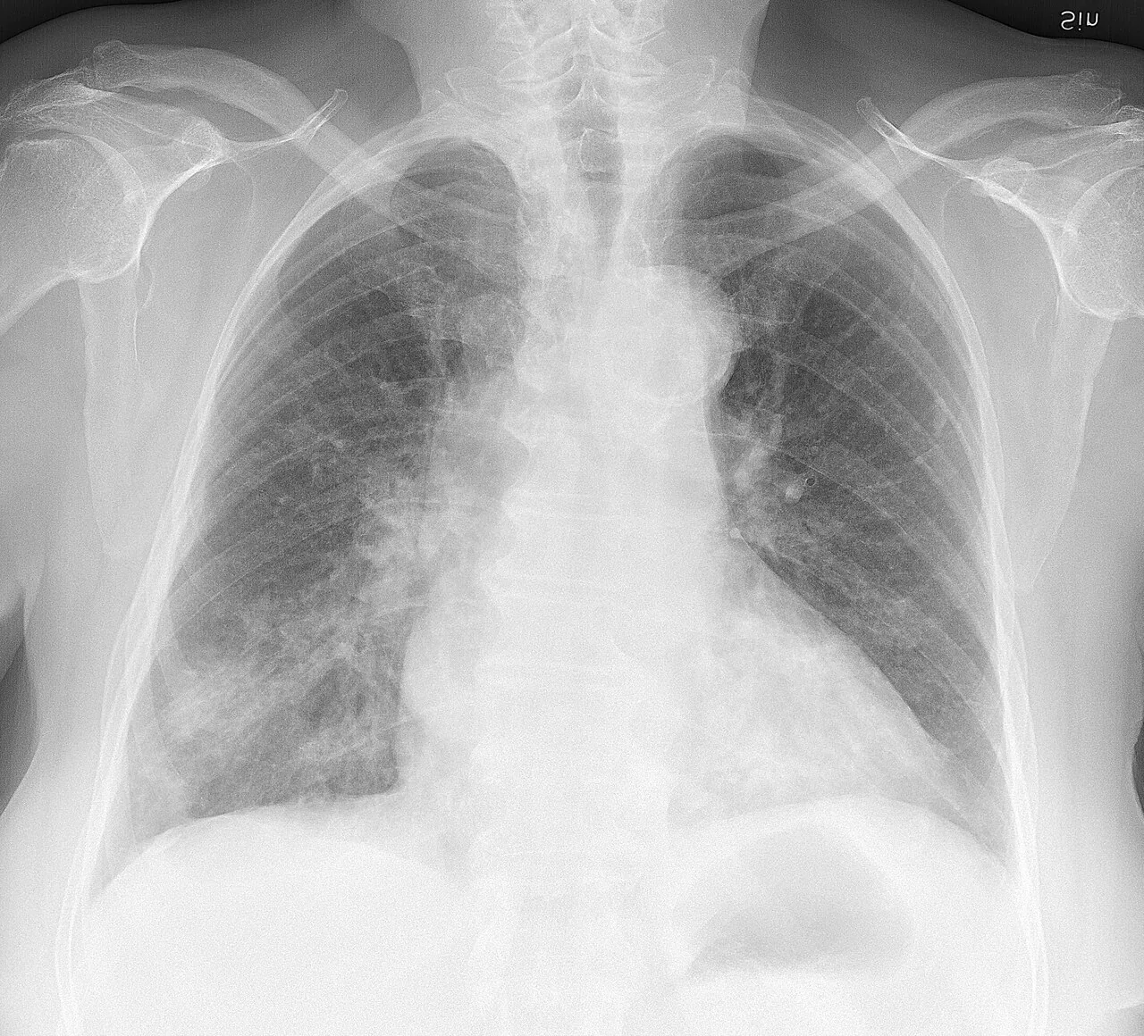 Chest radiograph for self-assessment