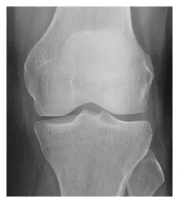 Radiograph from the case bank: Stress fracture