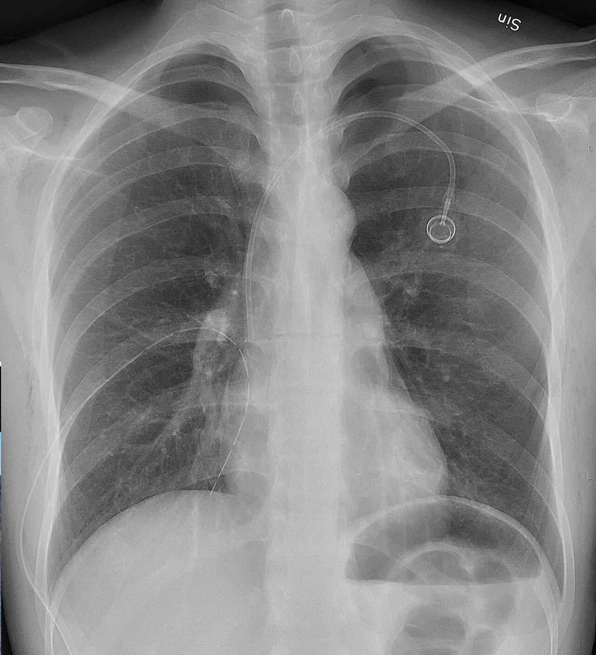 Chest radiograph for self-assessment