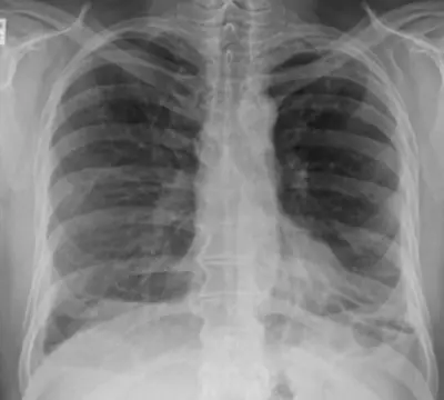 Radiograph from the case bank: Asbestos-related pleural disease