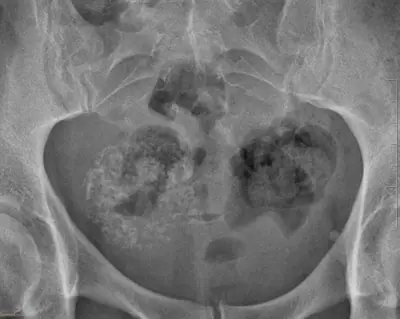 Radiograph from the case bank: Calcified uterine fibroid