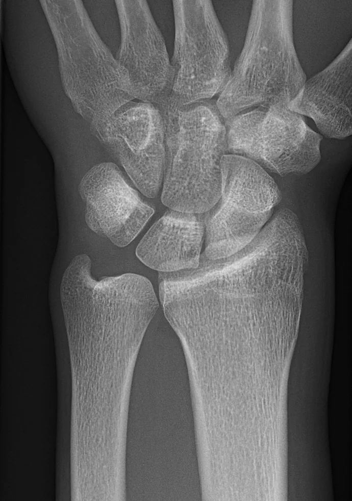 Upper limb radiograph for self-assessment