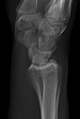 Radiograph from the case bank: Normal wrist radiograph