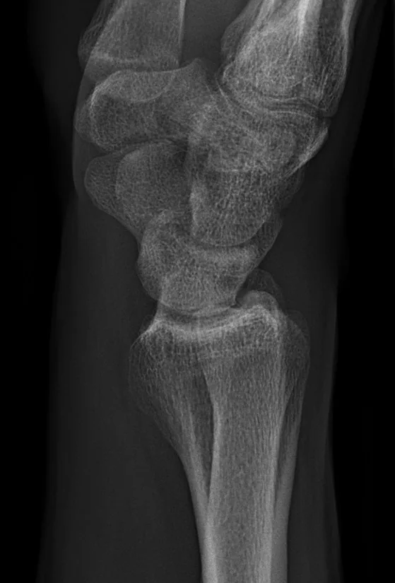 Upper limb radiograph for self-assessment