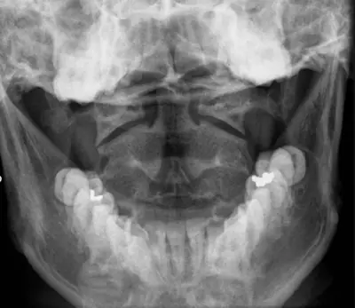Radiograph from the case bank: Normal cervical spine radiograph