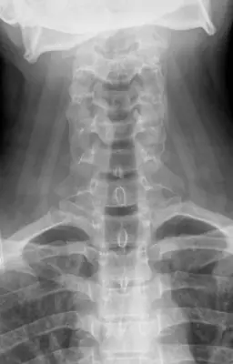 Radiograph from the case bank: Normal cervical spine radiograph