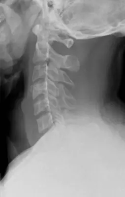 Radiograph from the case bank: Normal cervical spine radiograph