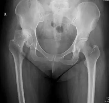 Radiograph from the case bank: Developmental dysplasia of the hip (DDH)