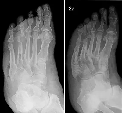 Radiograph from the case bank: Neuropathic (Charcot) arthropathy
