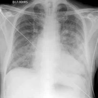 Radiograph from the case bank: Pulmonary oedema (heart failure)