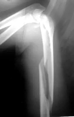 Radiograph from the case bank: Humeral shaft fracture