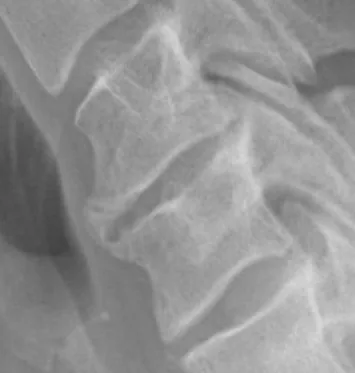 Spine radiograph for self-assessment