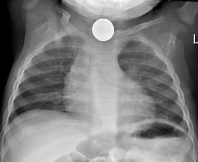 Radiograph from the case bank: Inhaled (aspirated) foreign body
