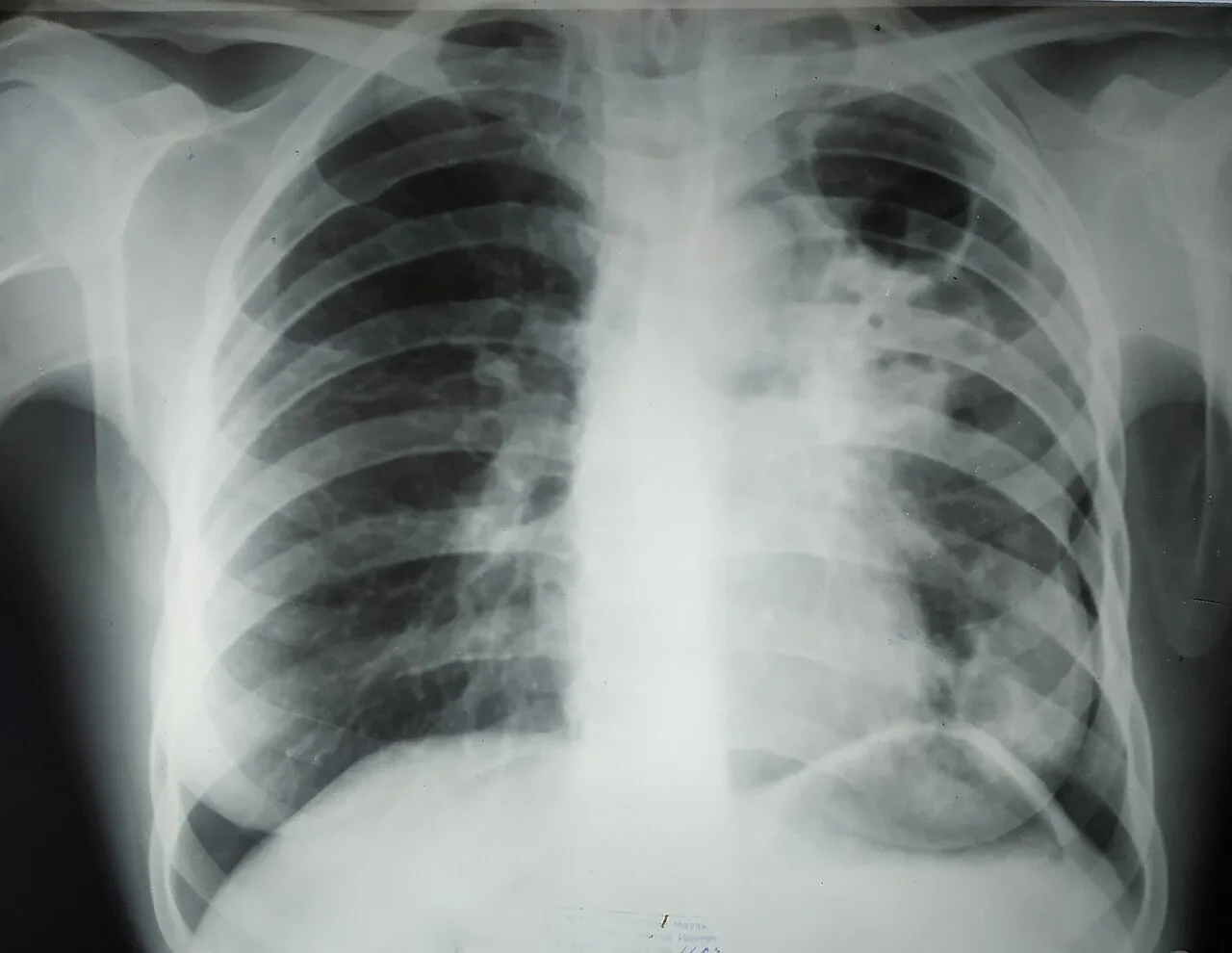 Chest radiograph for self-assessment