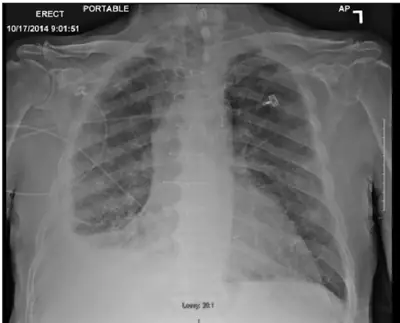 Radiograph from the case bank: Pleural effusion