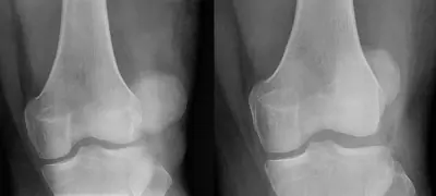 Radiograph from the case bank: Patellar dislocation