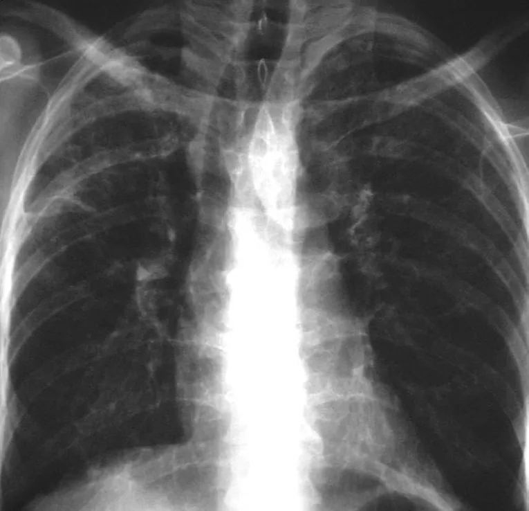 Chest radiograph for self-assessment