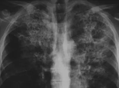 Radiograph from the case bank: Pneumocystis pneumonia (PCP)