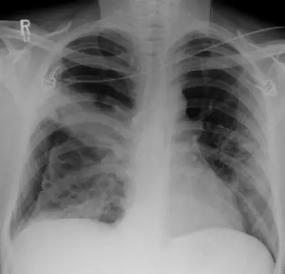 Radiograph from the case bank: Pneumocystis pneumonia (PCP)