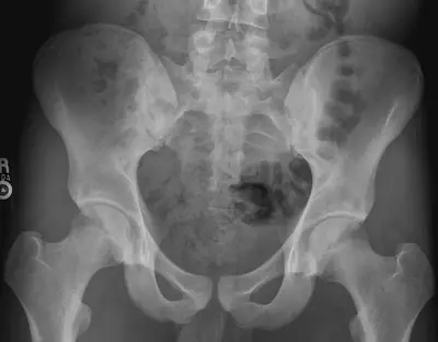 Radiograph from the case bank: Normal pelvis radiograph