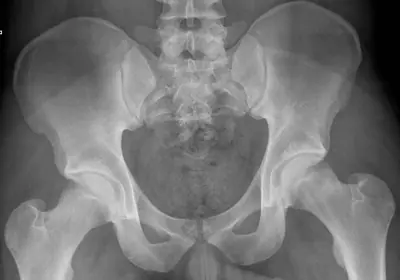 Radiograph from the case bank: Normal pelvis radiograph