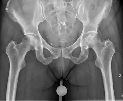 Radiograph from the case bank: Avascular necrosis of the femoral head