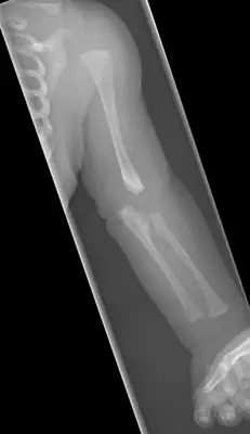 Radiograph from the case bank: Osteogenesis imperfecta