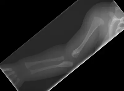 Radiograph from the case bank: Osteogenesis imperfecta