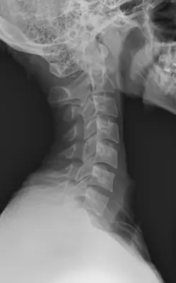 Radiograph from the case bank: Normal cervical spine radiograph