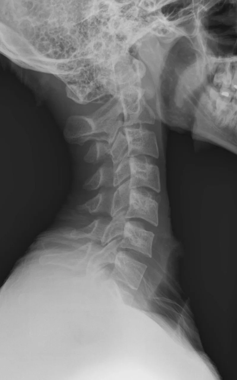 Spine radiograph for self-assessment