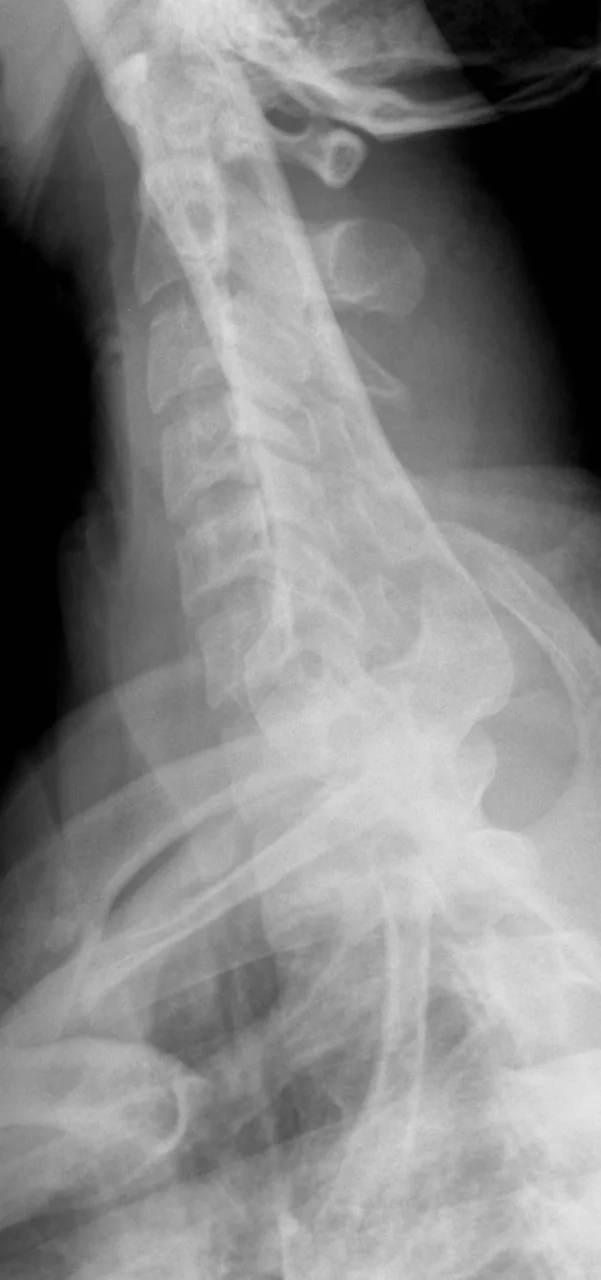 Spine radiograph for self-assessment
