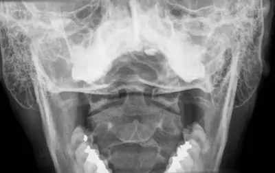 Radiograph from the case bank: Normal cervical spine radiograph