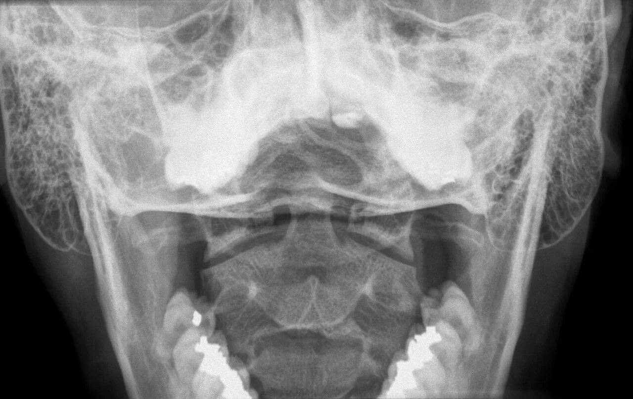 Spine radiograph for self-assessment