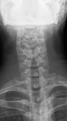 Radiograph from the case bank: Normal cervical spine radiograph