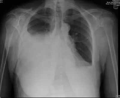 Radiograph from the case bank: Pleural effusion