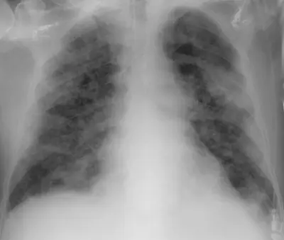 Radiograph from the case bank: COVID-19 pneumonia