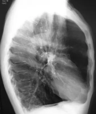 Radiograph from the case bank: Emphysema / COPD (hyperinflation)
