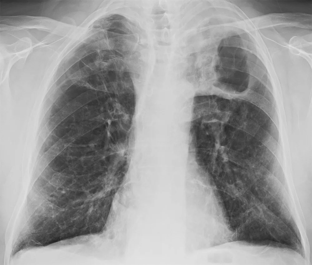 Chest radiograph for self-assessment