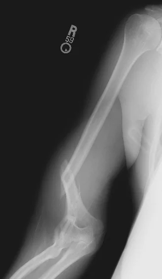 Upper limb radiograph for self-assessment