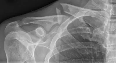 Radiograph from the case bank: Clavicle fracture