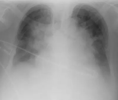 Radiograph from the case bank: Pulmonary oedema (heart failure)