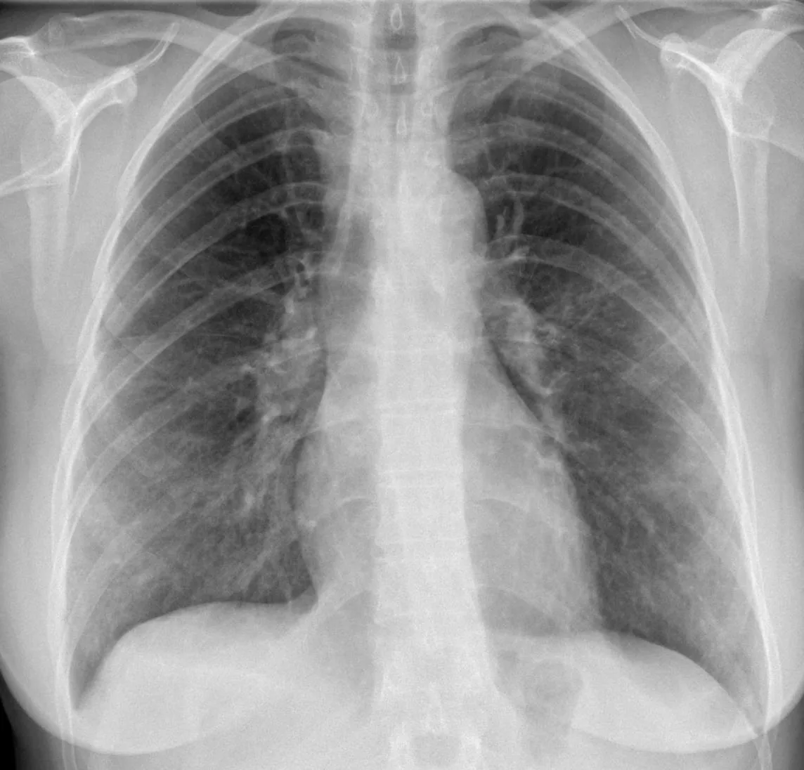 Chest radiograph for self-assessment