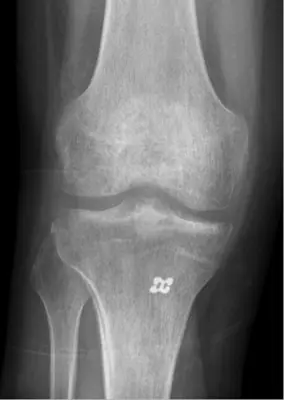 Radiograph from the case bank: Osteoporosis