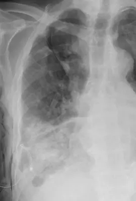 Radiograph from the case bank: Pneumothorax