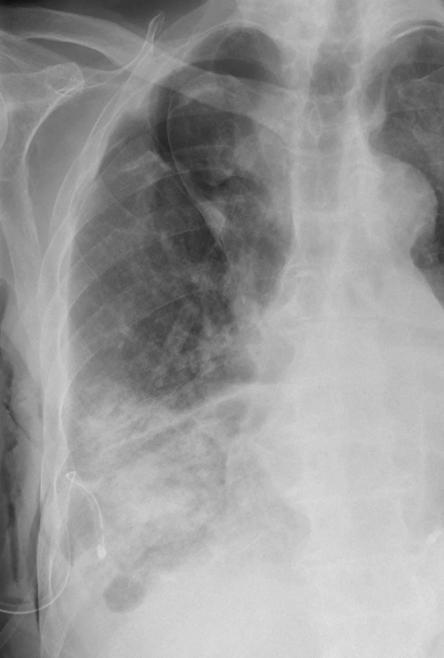 Chest radiograph for self-assessment