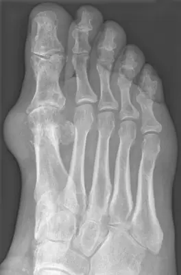 Radiograph from the case bank: Gout
