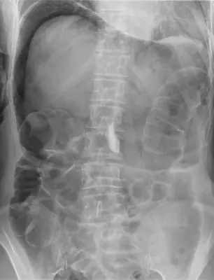 Radiograph from the case bank: Pneumoperitoneum (free intraperitoneal gas)