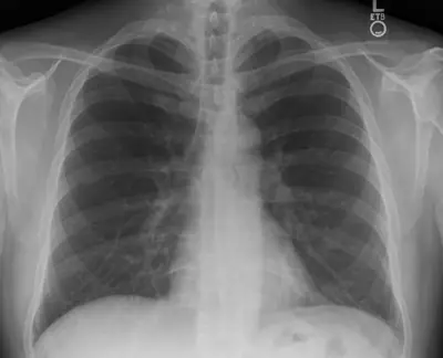 Radiograph from the case bank: Normal chest radiograph