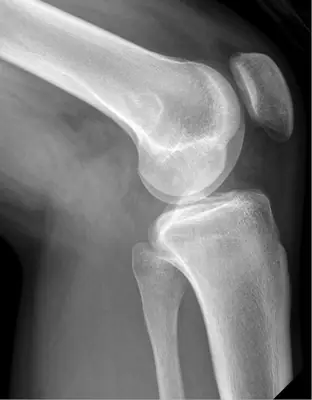 Radiograph from the case bank: Non-ossifying fibroma