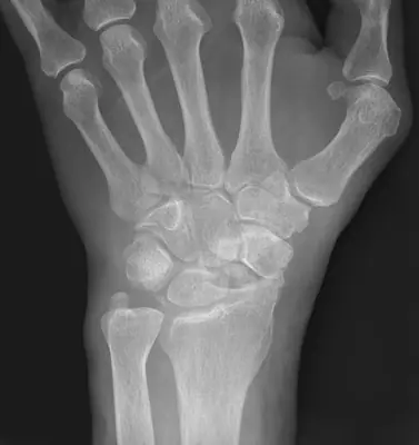 Radiograph from the case bank: Scaphoid fracture